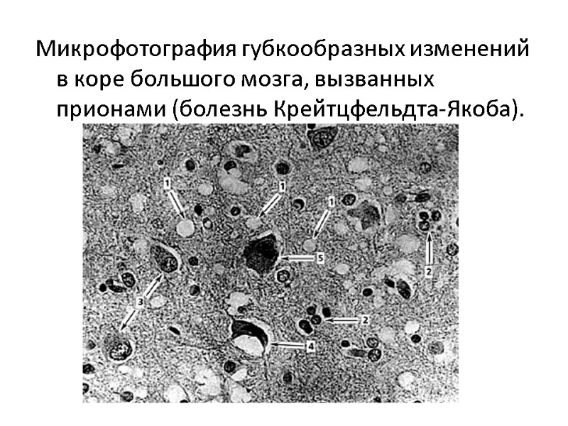 Микрофотография губкообразных изменений в коре большого мозга, вызванных прионами (болезнь Крейтцфельдта-Якоба).